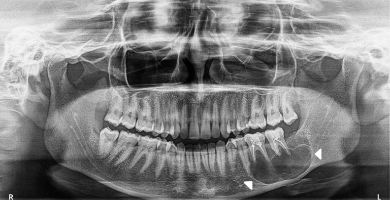 Indicaciones De La Radiograf A Panor Mica Dento Metric Radiolog A