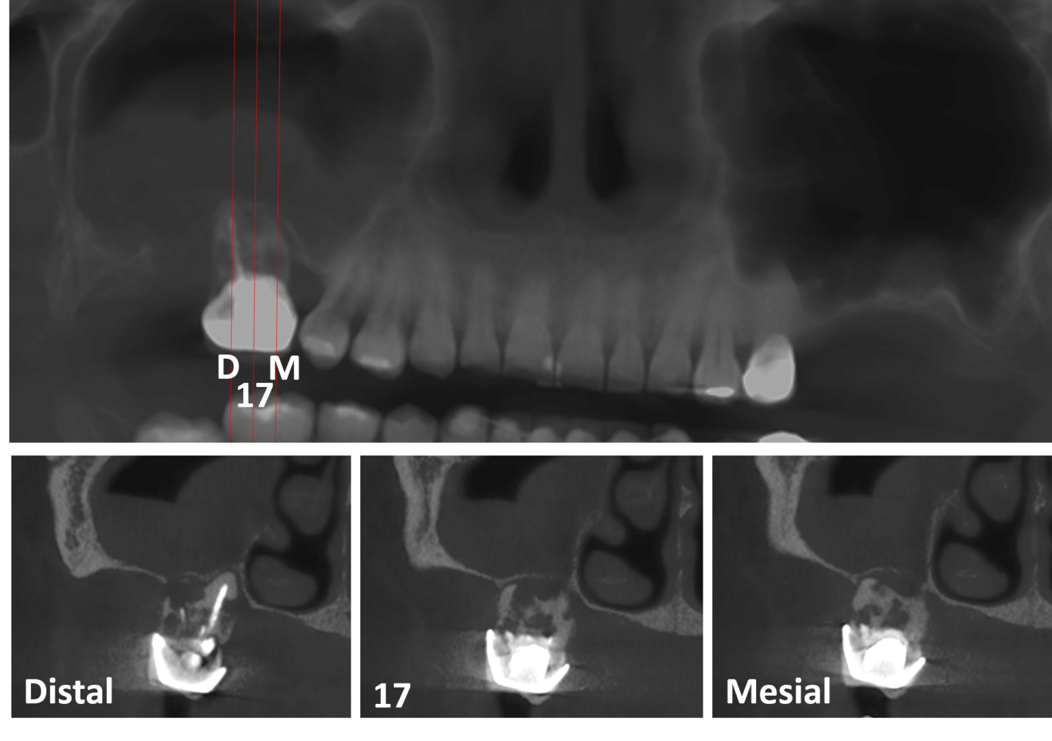 Reabsorción radicular interna en un segundo molar superior Dento