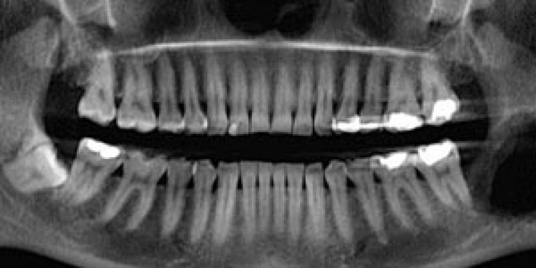 Dento Metric Radiología Dental Oral Y Maxilofacial Dento Metric
