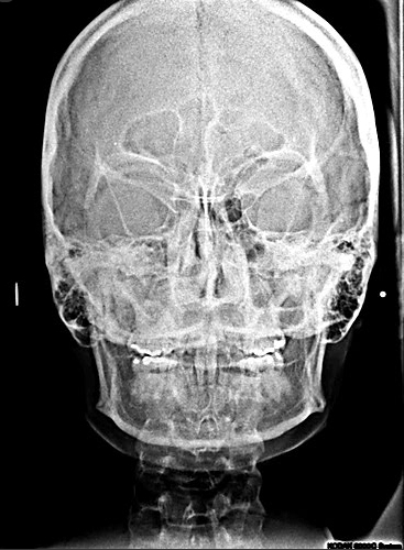 Dento Metric Radiografías Extraorales Caldwell