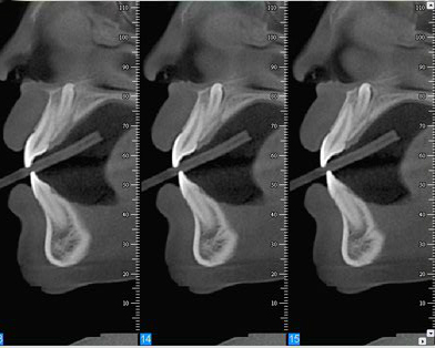 Dento Metric Tomografía Cone Beam Dientes Impactados