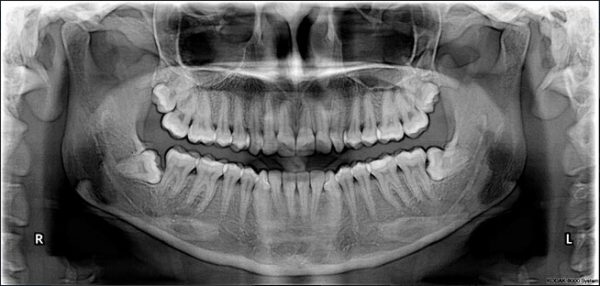 Radiografías Extraorales Ortopantomografía – Dento Metric | Radiología ...