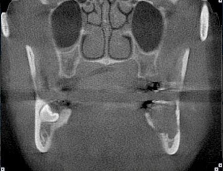 Dento Metric Cone Beam Tomografía de Patología