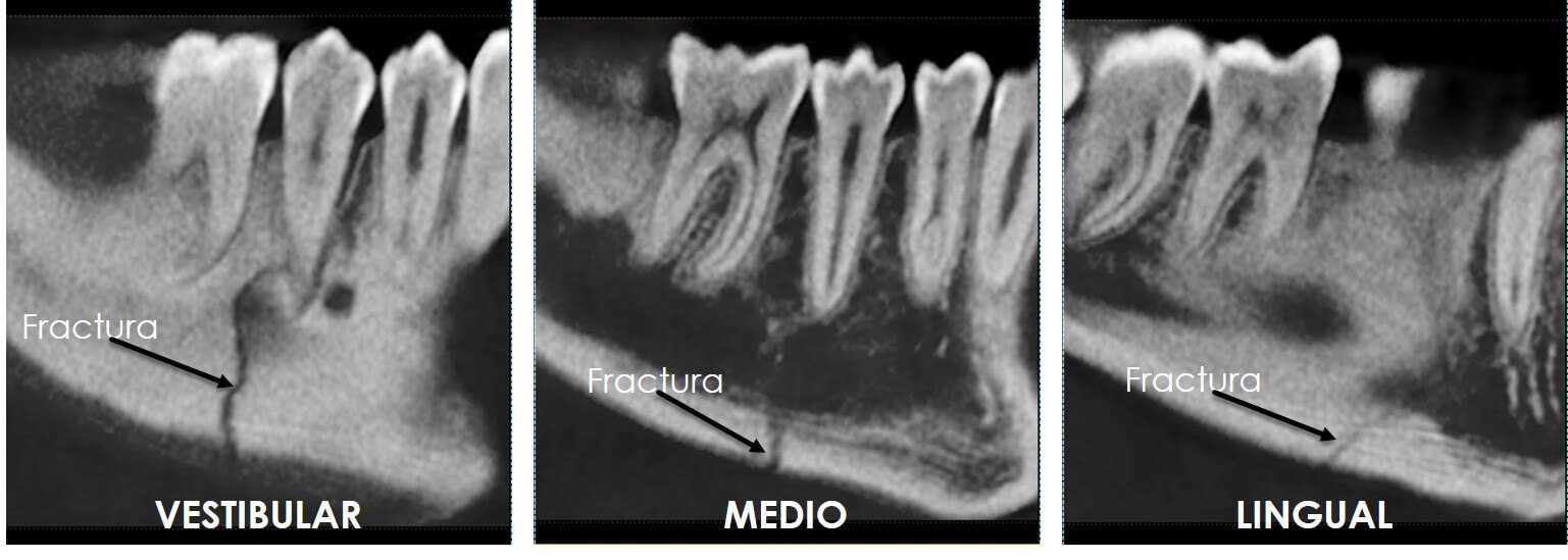 Radiografia de maxilar y mandibula