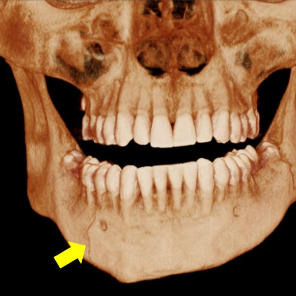 Fractura De Maxilares 2609