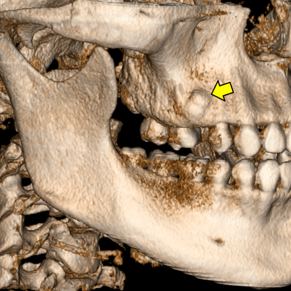 Odontoma Compuesto