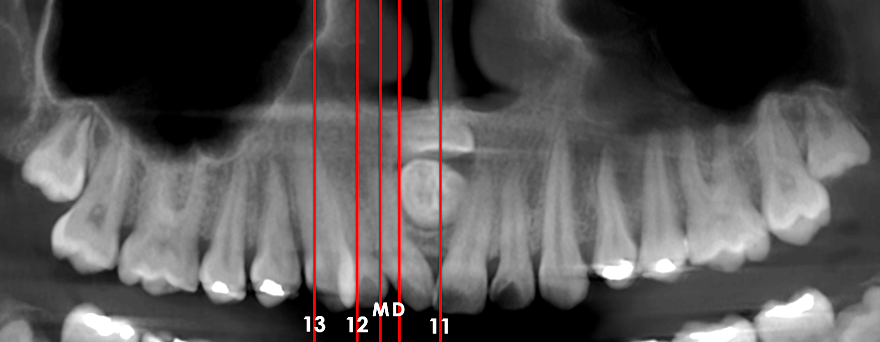 Mesiodentes Dento Metric Radiología Maxilofacial Y Oral