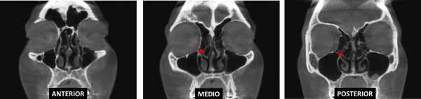 Concha Bullosa – Dento Metric | Radiología Dental, Oral y Maxilofacial