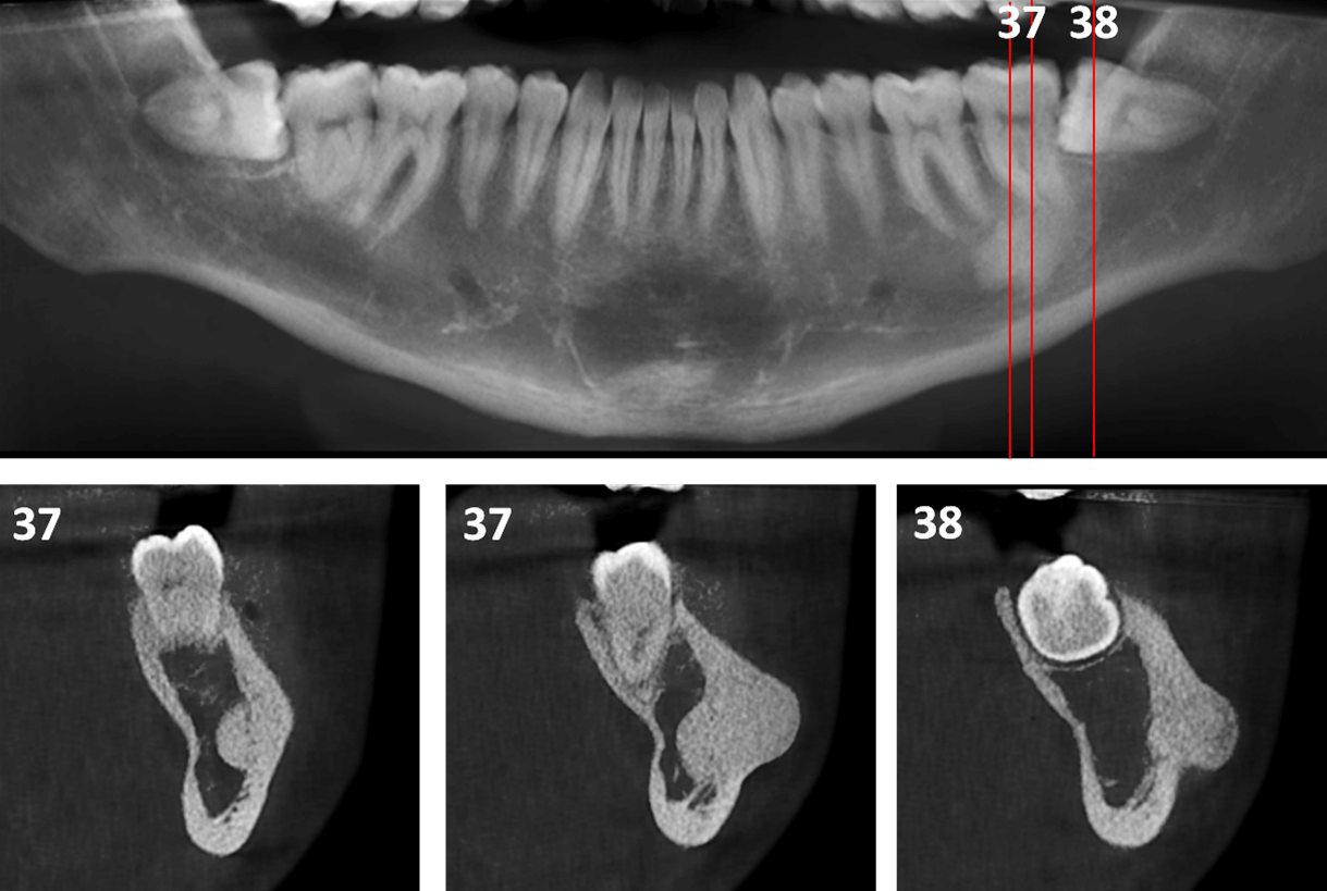 Osteoma Periférico en Mandíbula – Dento Metric | Radiología Dental ...