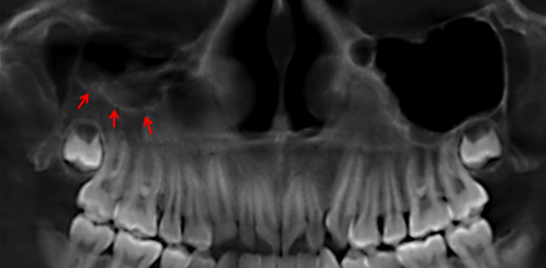 Hipopl Sia Del Seno Maxilar Dento Metric Radiolog A Dental Oral Y