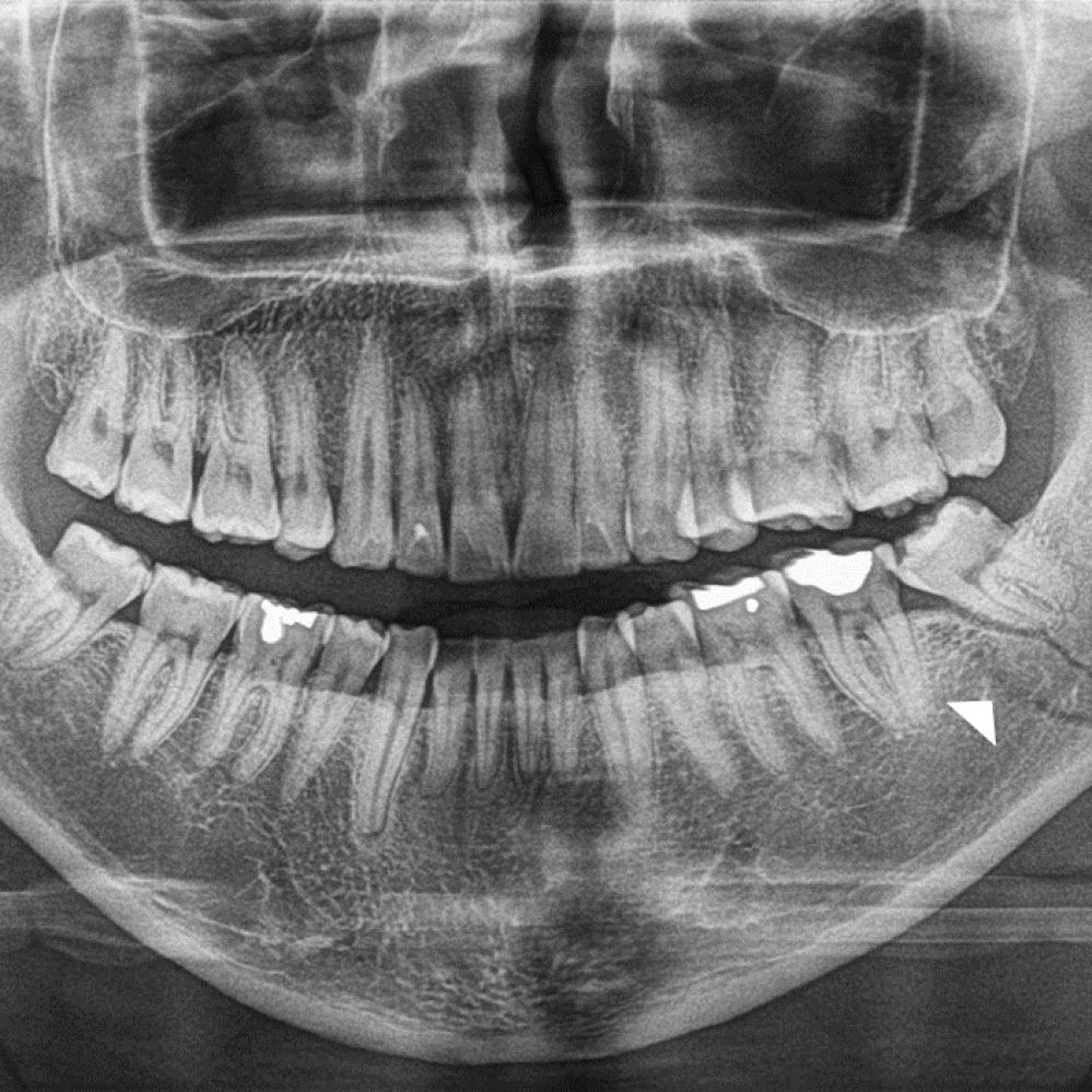 Indicaciones de la Radiografía de ATM