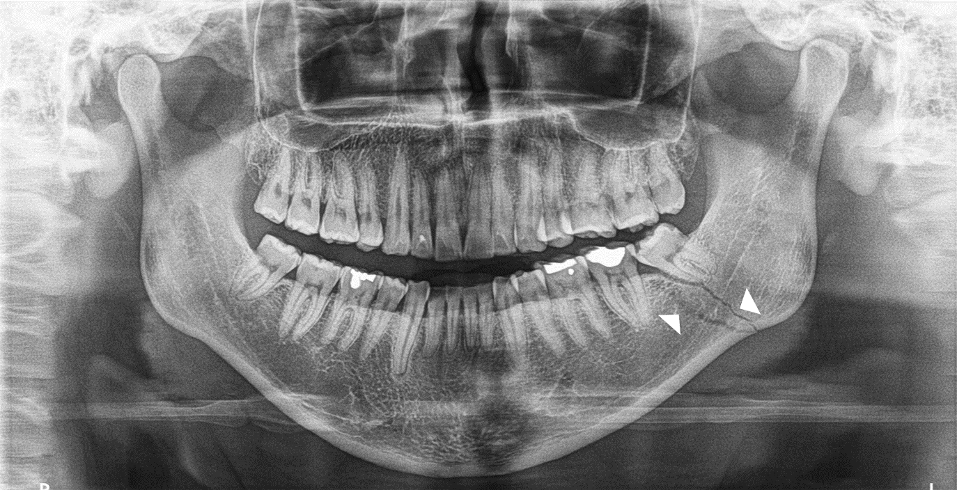 Radiografia de maxilar y mandibula