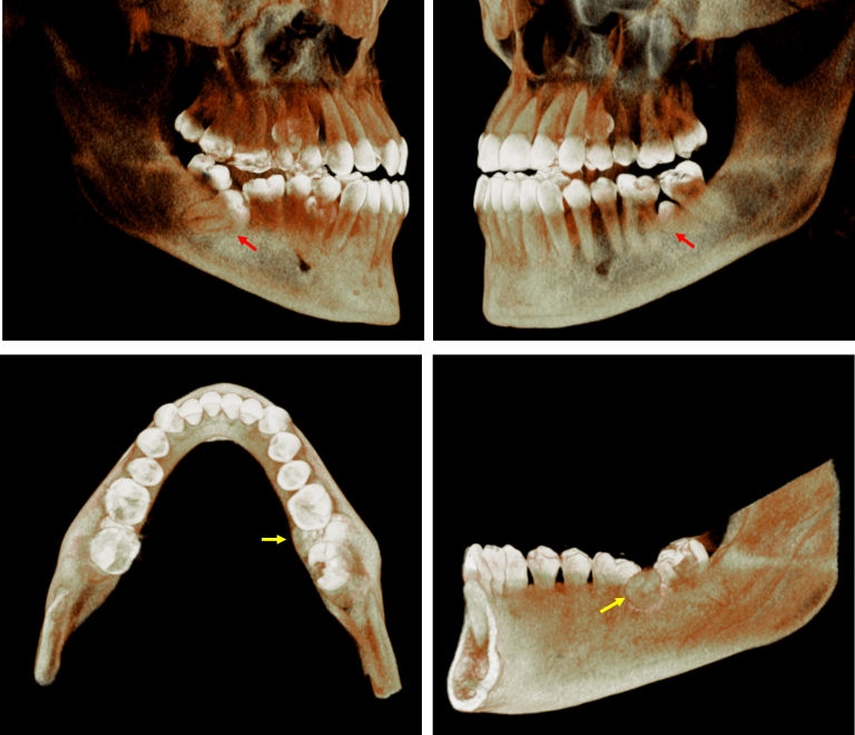 Segundos Molares Mandibulares Impactados Dento Metric Radiología Dental Oral Y Maxilofacial 4212