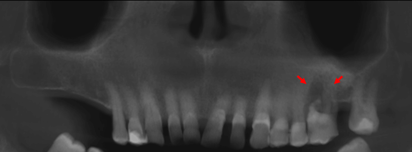 Reabsorci n Radicular Asociada A Una Lesi n Osteol tica Dento Metric Reabsorci n Radicular Asociada A Una Lesi n Osteol tica Dento Metric
