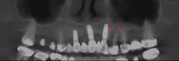 Fractura Vertical En Un Premolar Superior Con Endodoncia Dento Metric Radiología Dental