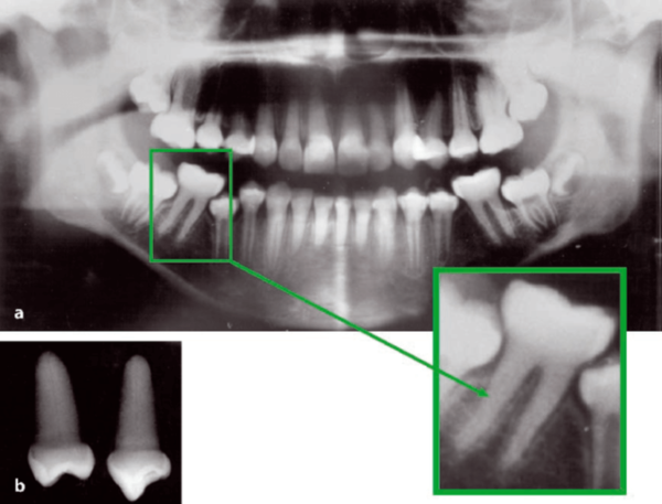 Revisión De Artículo 24 – Dento Metric | Radiología Dental, Oral Y ...