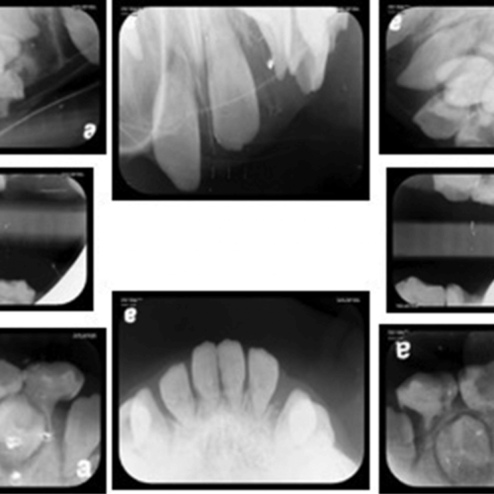 Indicaciones de la radiografía periapical