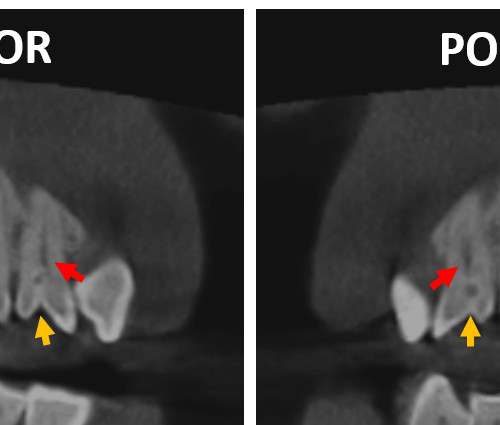 EVALUACIÓN TOMOGRÁFICA DE LA CALCIFICACIÓN DEL CARTÍLAGO TIROIDES