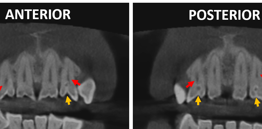 EVALUACIÓN TOMOGRÁFICA DE LA CALCIFICACIÓN DEL CARTÍLAGO TIROIDES