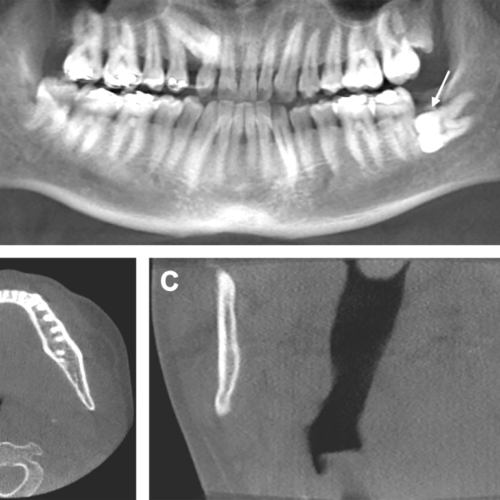 Indicaciones de la radiografía de ATM