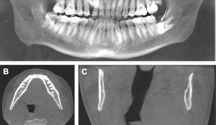 Indicaciones de la radiografía de ATM