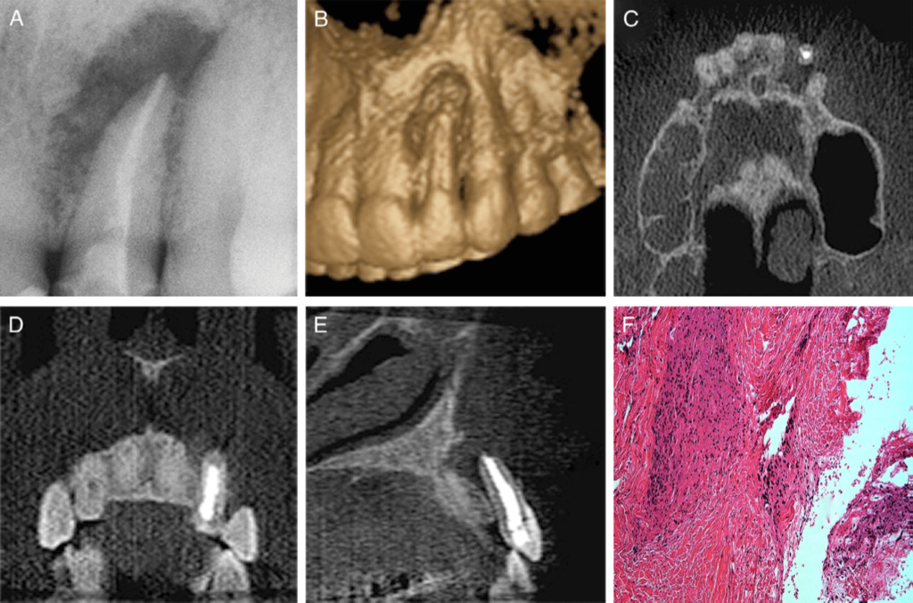 Diagnóstico diferencial entre el granuloma periapical y el quiste