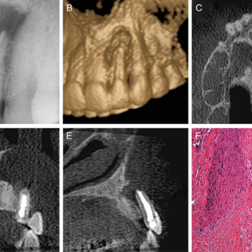 Diagnóstico diferencial entre el granuloma periapical y el quiste periapical