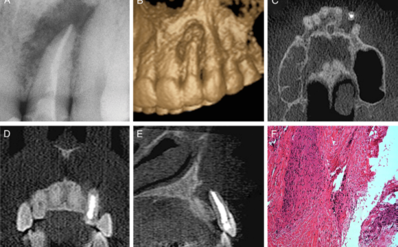 Diagnóstico diferencial entre el granuloma periapical y el quiste periapical
