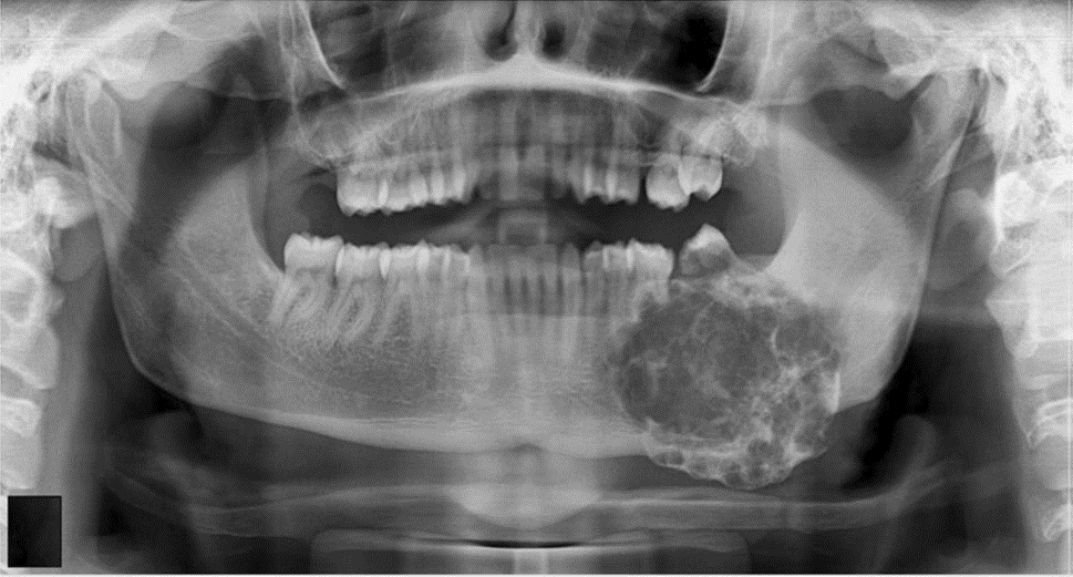 Radiografia de maxilar y mandibula