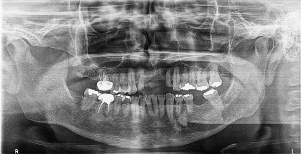 Defecto seo En Maxilar Superior Asociado A Un Incisivo Lateral Dento Defecto seo En Maxilar Superior Asociado A Un Incisivo Lateral Dento