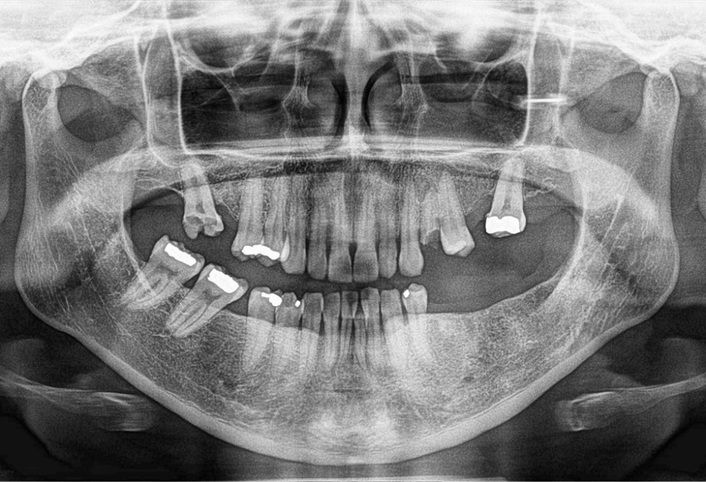 Torus Mandibular Dento Metric Radiología Dental Oral Y Maxilofacial 7460