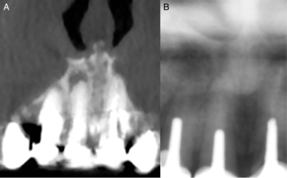 Comparación Entre La Evaluación Radiográfica Y Tomográfica Para Detectar Periodontitis Apical 9482