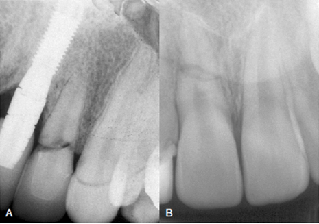 Evaluaci n Radiogr fica De Las Fracturas Dentarias Dento Metric Evaluaci n Radiogr fica De Las Fracturas Dentarias Dento Metric