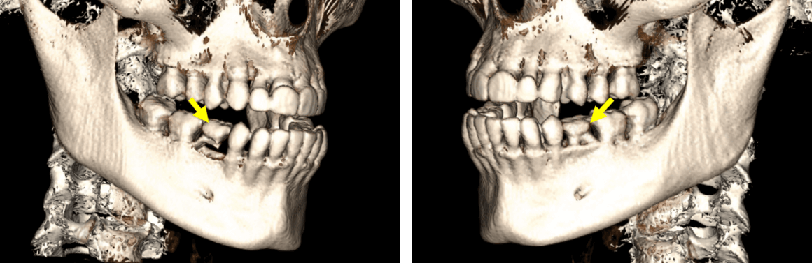 Agenesia De Segundos Premolares Mandibulares – Dento Metric ...