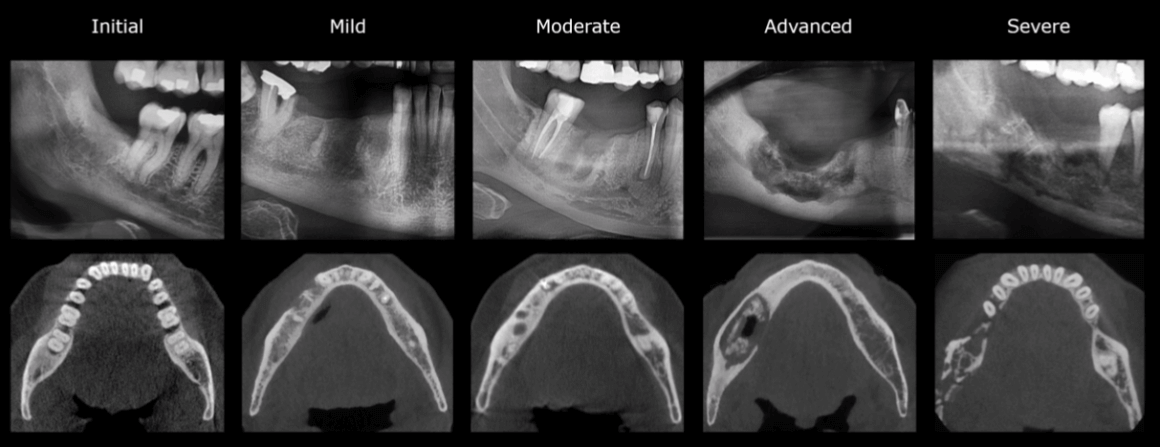 Radiolog a De Las Lesiones Osteonecr ticas Dento Metric Radiolog a Radiolog a De Las Lesiones Osteonecr ticas Dento Metric Radiolog a