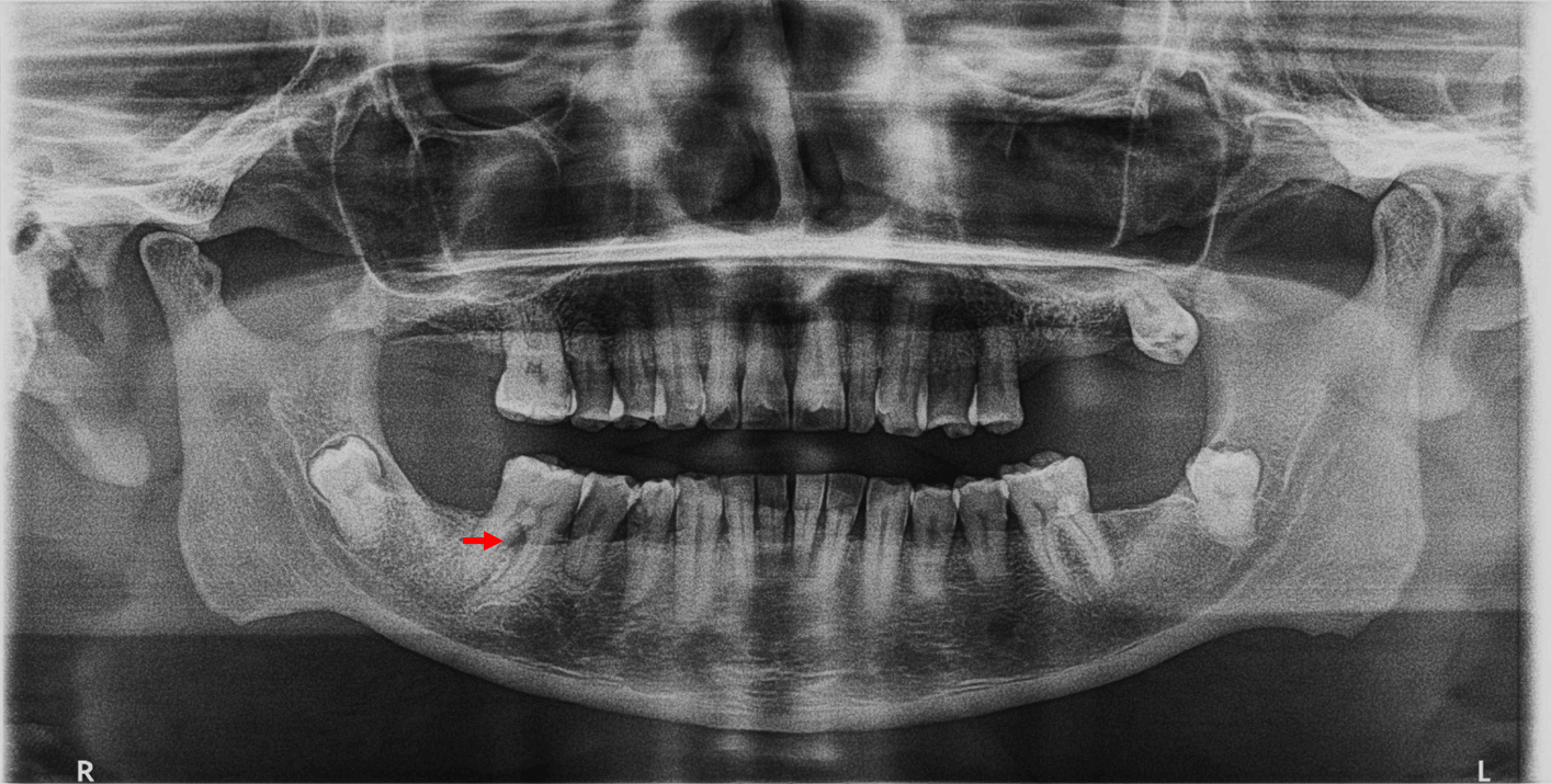 Lesion En La Furcaci n De Un Molar Inferior Dento Metric Radiolog a Lesion En La Furcaci n De Un Molar Inferior Dento Metric Radiolog a