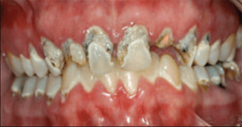 Manifestaciones orales del abuso de metanfetaminas