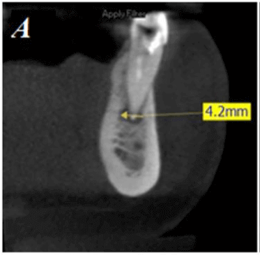 Reparación apical en endodoncia evaluado por tomografía
