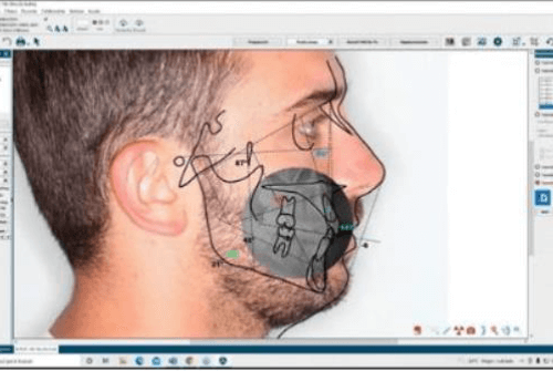 Ventajas del análisis cefalométrico asistido por computadora