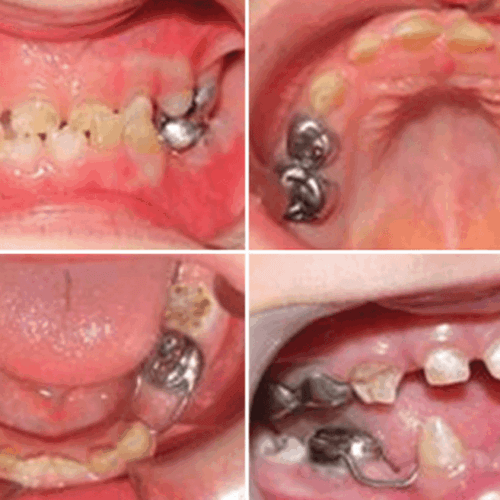 Dentinogéness Imperfecta asociada a Osteogénesis Imperfecta