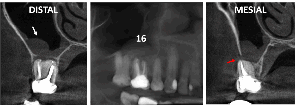 1 Periodontitis apical y mucositis antral en relación con un tratamiento de endodoncia