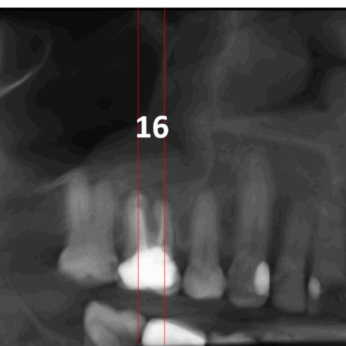 Periodontitis apical y mucositis antral en relación con un tratamiento de endodoncia