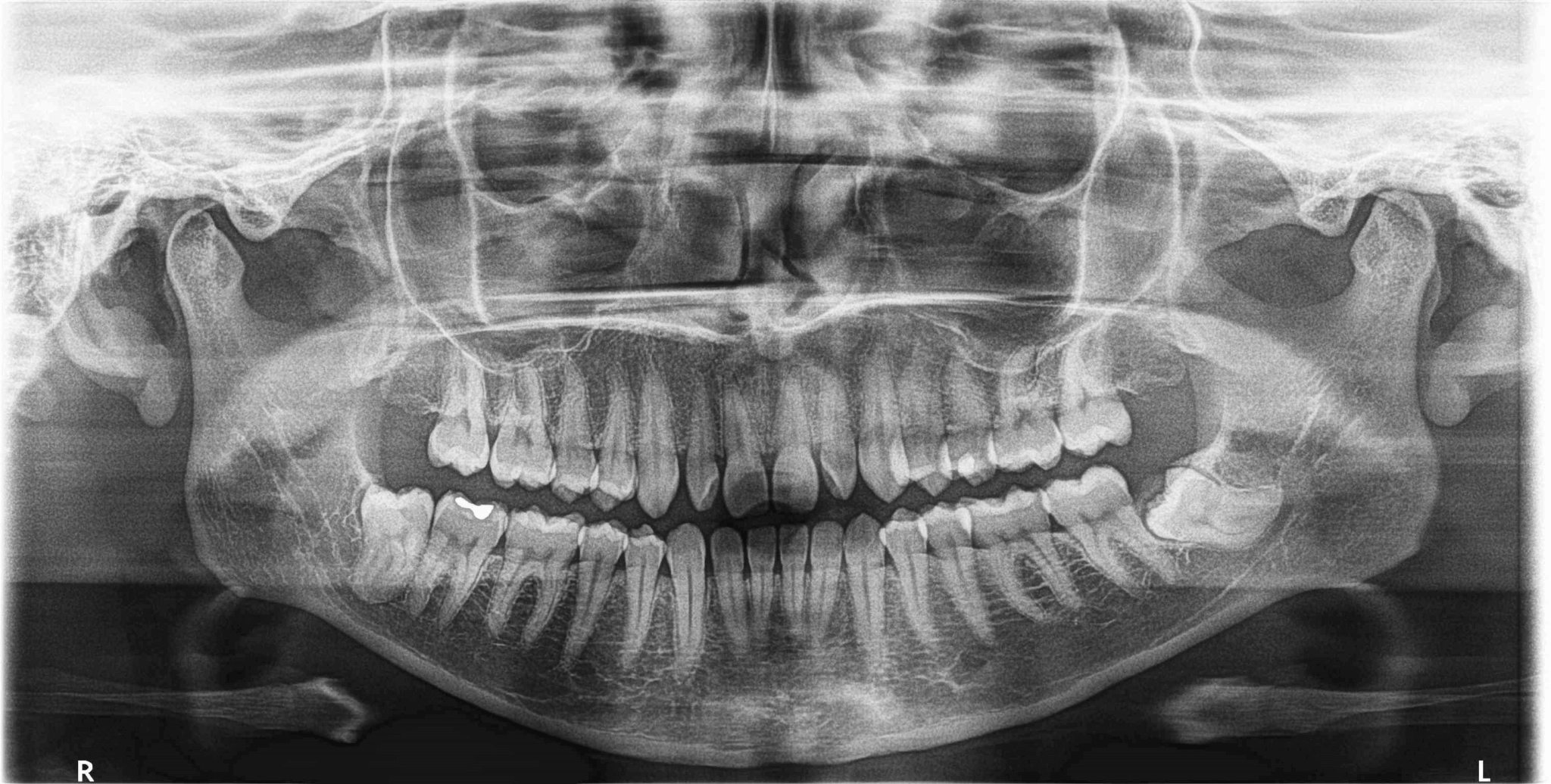 Cómo corregir los dientes en forma de clavija? | Clínica Dental Villalaín Cómo corregir los dientes en forma de clavija? | Clínica Dental Villalaín