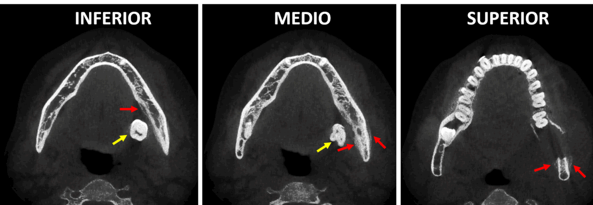 Tercer molar desplazado en el espacio sublingual