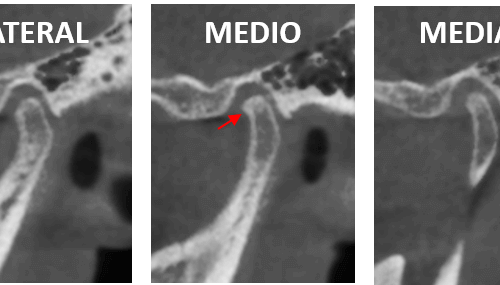 Trastorno temporomandibular asociado a la exodoncia de terceros molares