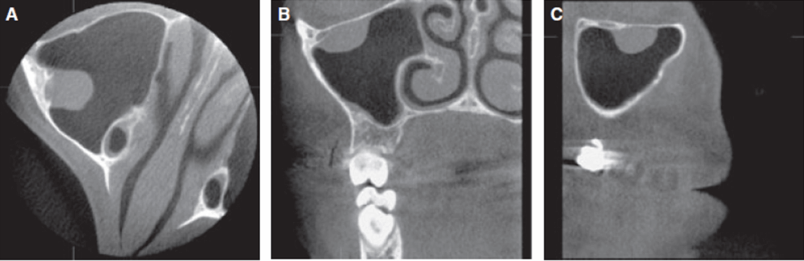 Cambios en la mucosa sinusal detectados en tomografías para ortodoncia