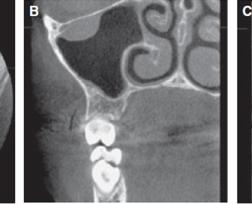 Cambios en la mucosa sinusal detectados en tomografías para ortodoncia