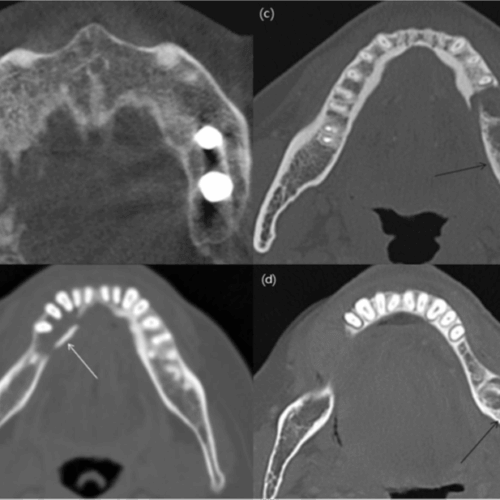 Signos radiológicos de la osteonecrosis de los maxilares relacionada con medicamentos