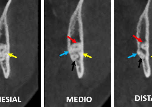 Tercer molar mandibular con 4 raíces
