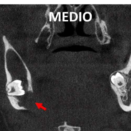 Lesion osteolítica en cuerpo y rama ascendente mandibular